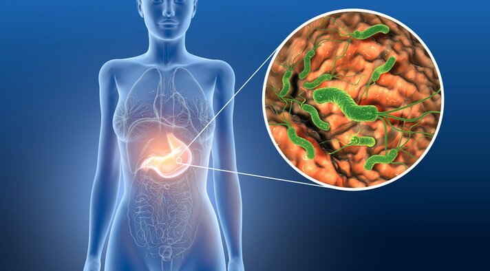 Роль запалення, асоційованого з Helicobacter pylori, в розвитку раку шлунка Роль запалення, асоційованого з Helicobacter pylori, в розвитку раку шлунка