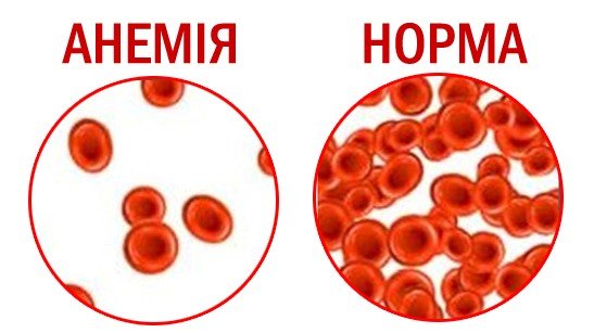 ЩО ТАКЕ АНЕМІЯ. Анемія у дітей. ЩО ТАКЕ АНЕМІЯ. Анемія у дітей.